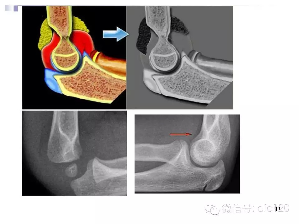 儿童肘关节骨折X线诊断