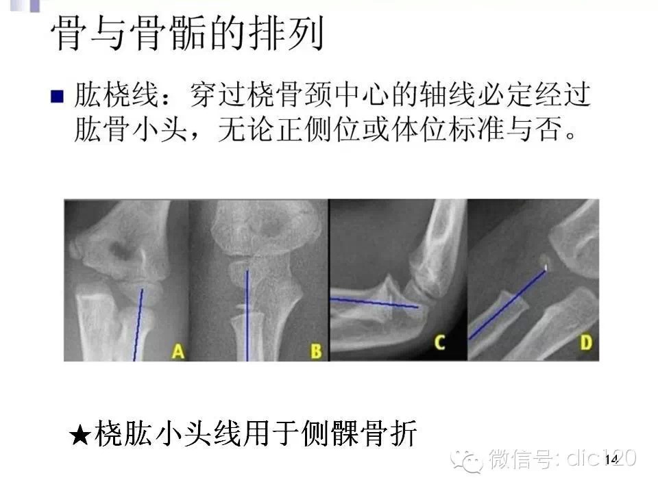 儿童肘关节骨折X线诊断