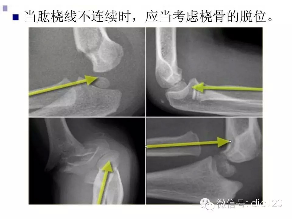 儿童肘关节骨折X线诊断