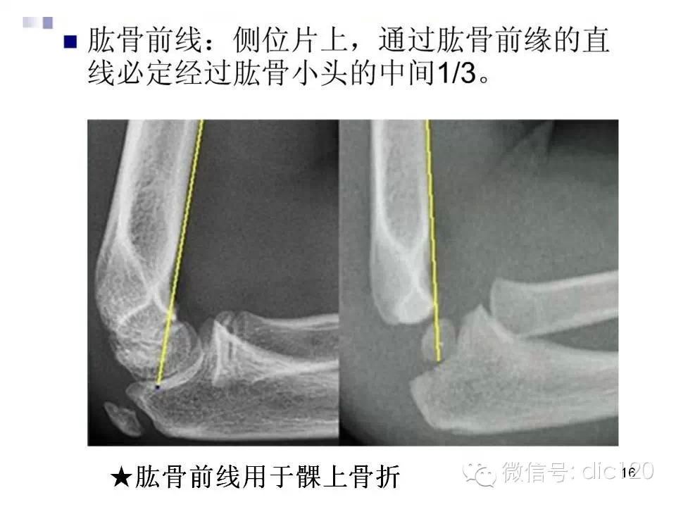 儿童肘关节骨折X线诊断