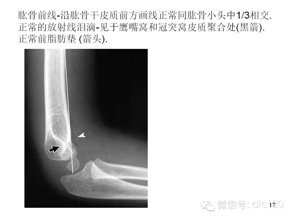 儿童肘关节骨折X线诊断
