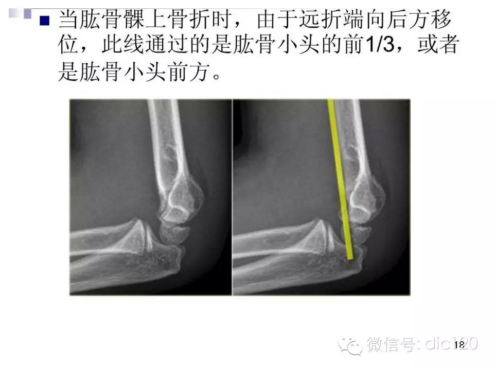 儿童肘关节骨折X线诊断