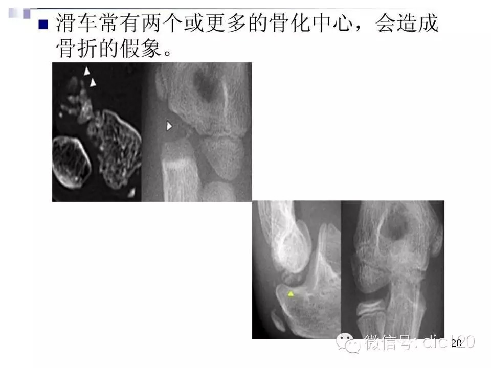 儿童肘关节骨折X线诊断