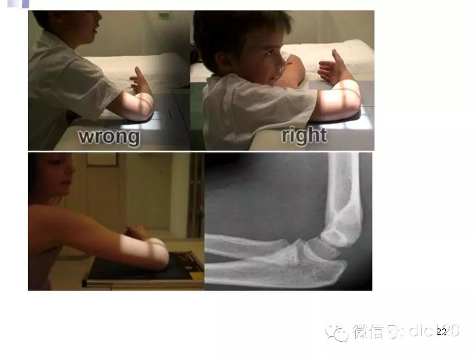儿童肘关节骨折X线诊断