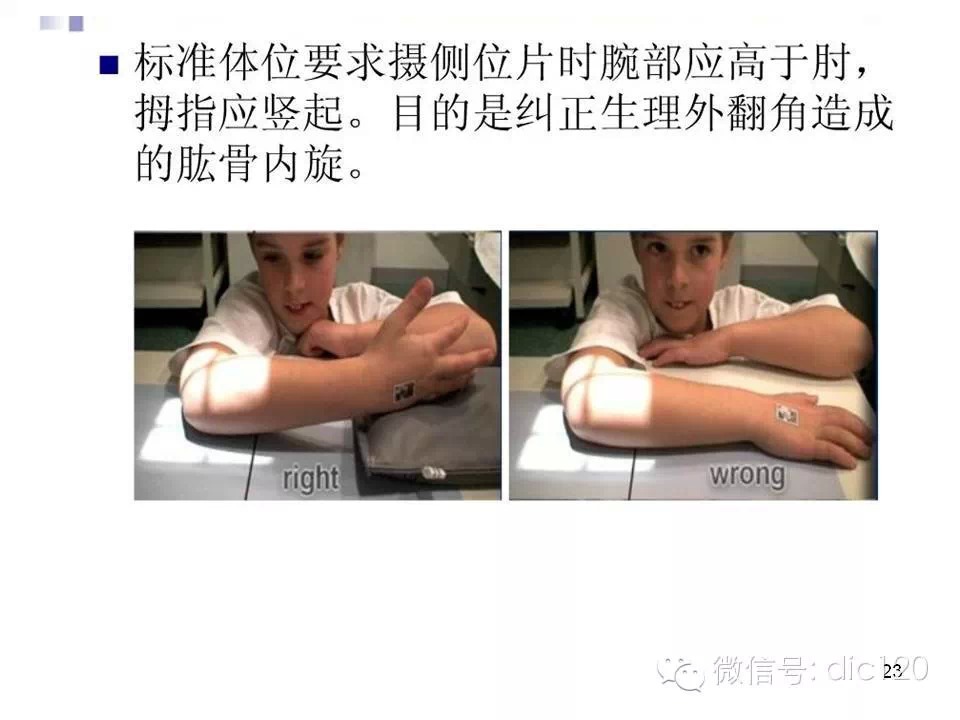 儿童肘关节骨折X线诊断