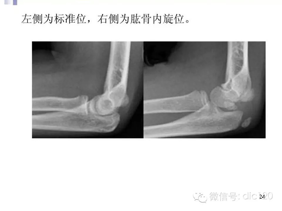 儿童肘关节骨折X线诊断