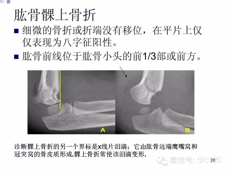 儿童肘关节骨折X线诊断