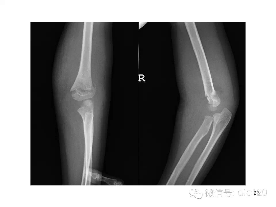 儿童肘关节骨折X线诊断