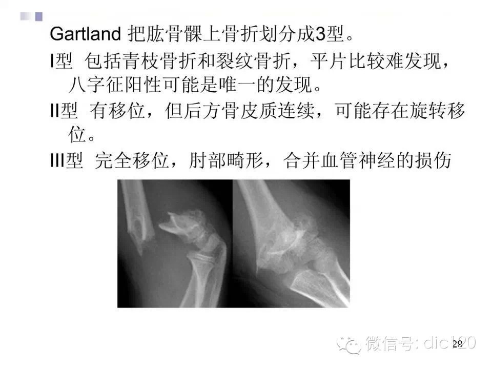 儿童肘关节骨折X线诊断