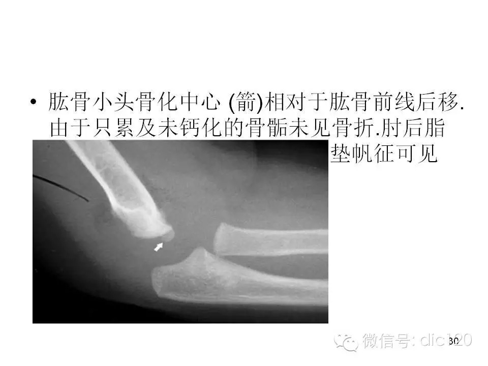 儿童肘关节骨折X线诊断