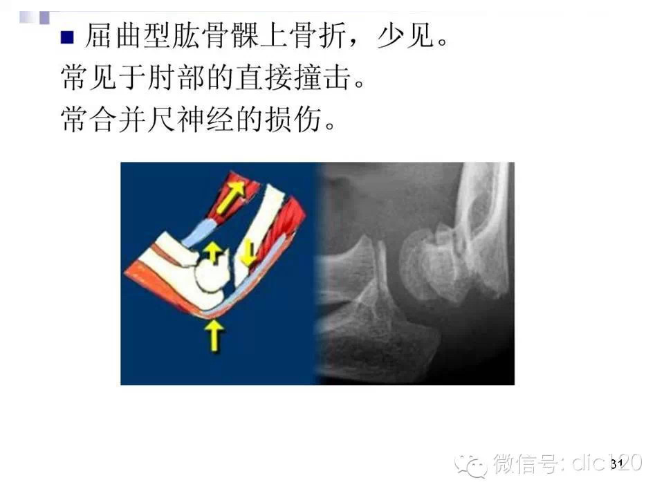 儿童肘关节骨折X线诊断
