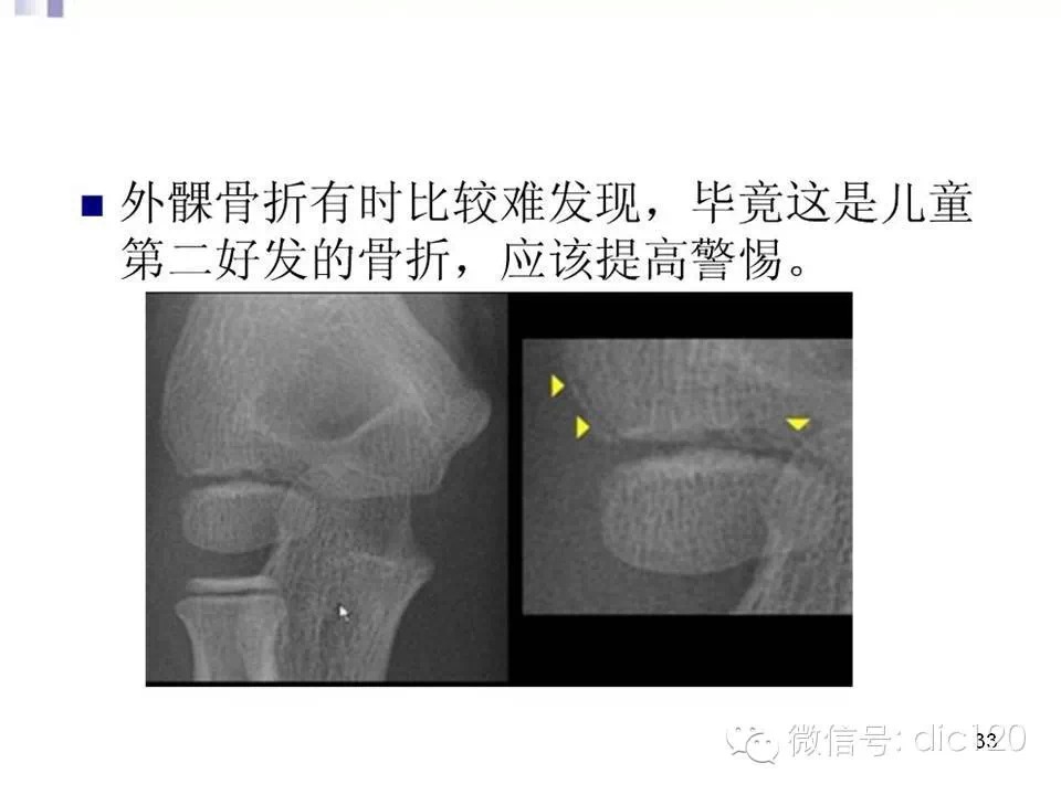儿童肘关节骨折X线诊断