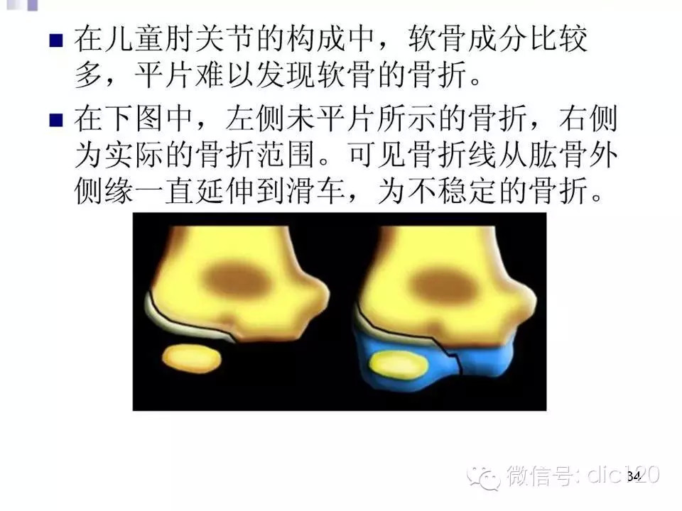 儿童肘关节骨折X线诊断