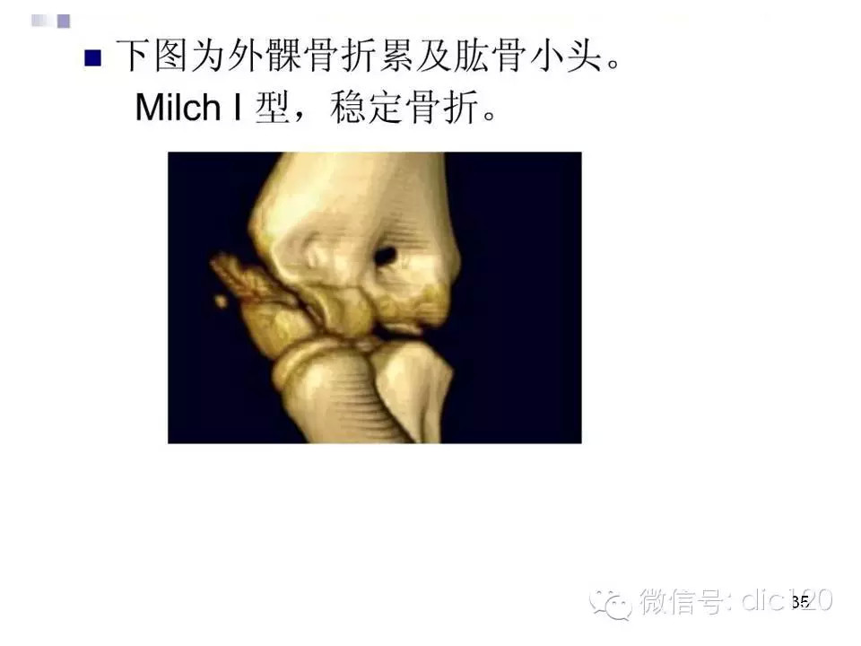儿童肘关节骨折X线诊断