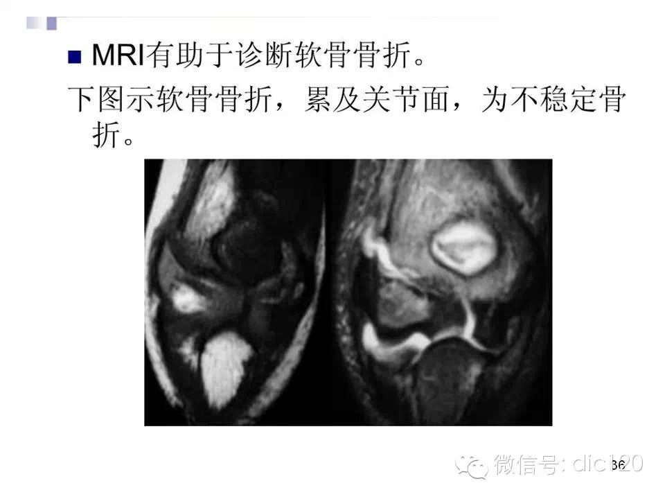 儿童肘关节骨折X线诊断