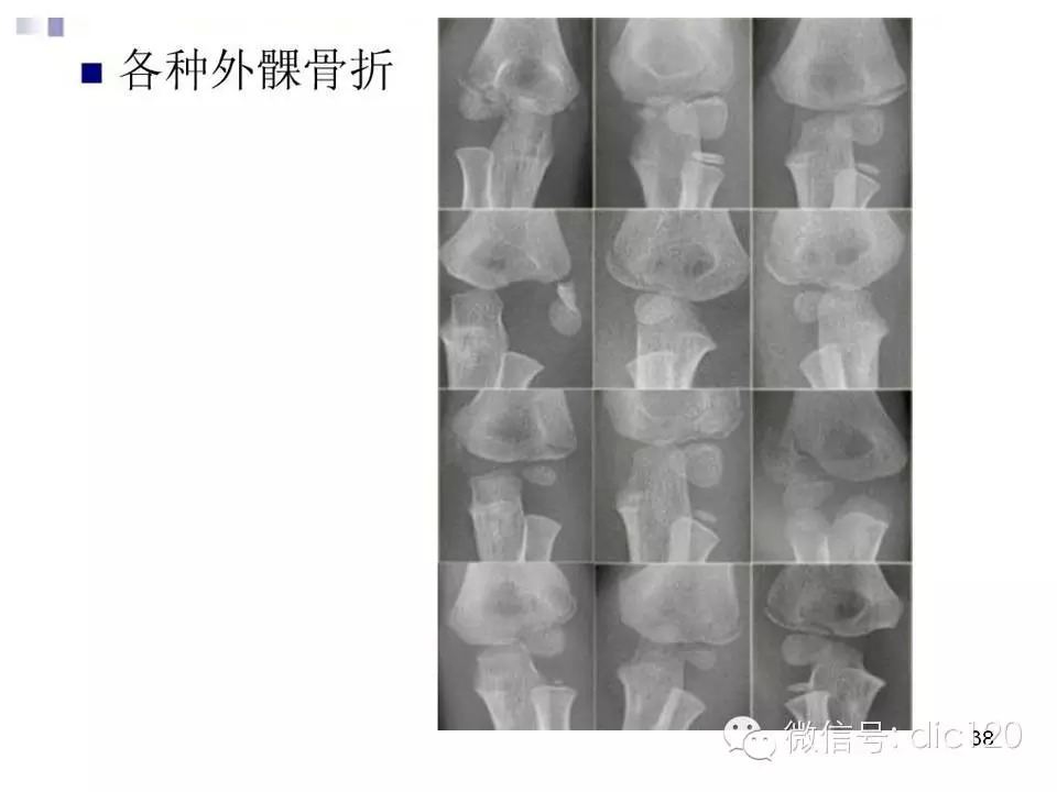 儿童肘关节骨折X线诊断