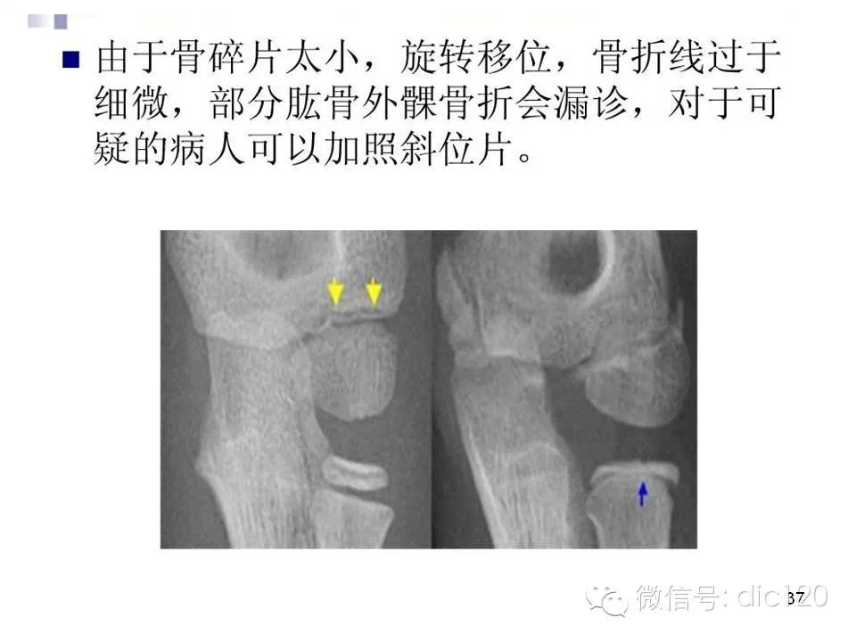 儿童肘关节骨折X线诊断