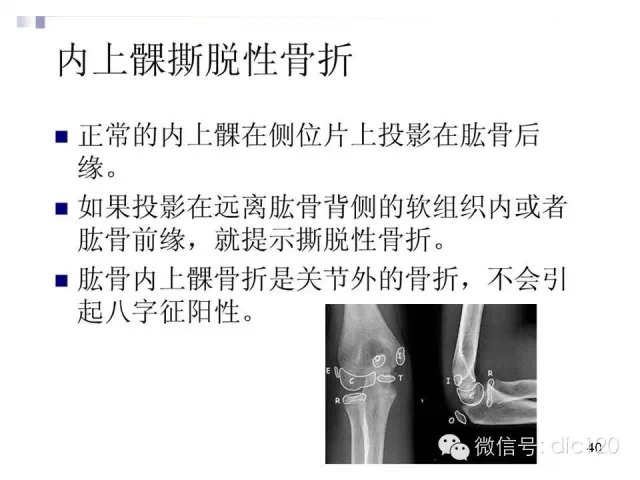 儿童肘关节骨折X线诊断