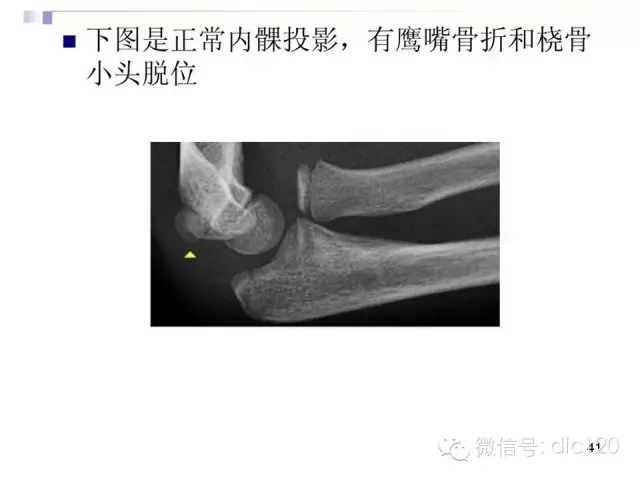 儿童肘关节骨折X线诊断