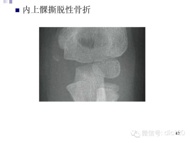 儿童肘关节骨折X线诊断