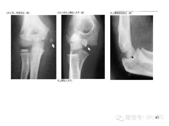 儿童肘关节骨折X线诊断