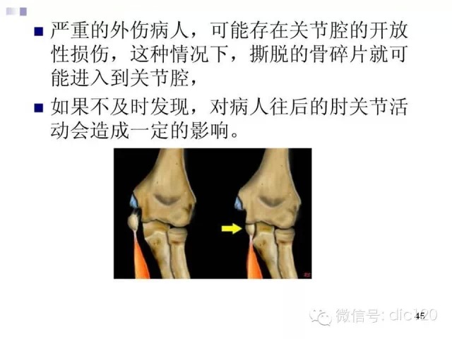 儿童肘关节骨折X线诊断