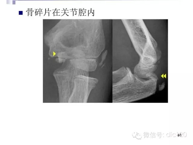 儿童肘关节骨折X线诊断
