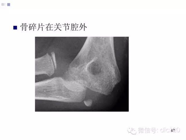 儿童肘关节骨折X线诊断