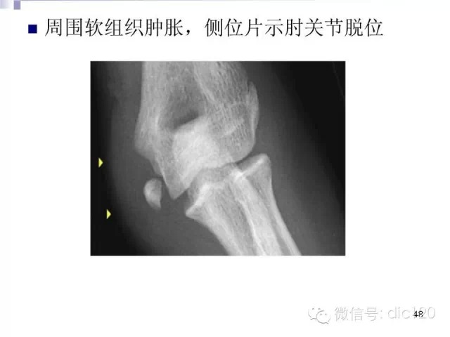 儿童肘关节骨折X线诊断