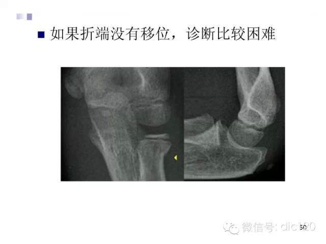儿童肘关节骨折X线诊断