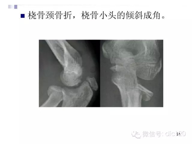 儿童肘关节骨折X线诊断