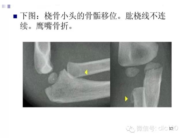 儿童肘关节骨折X线诊断