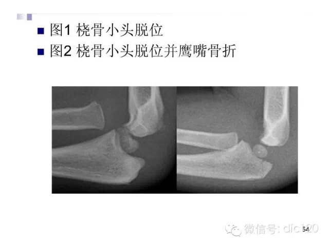 儿童肘关节骨折X线诊断