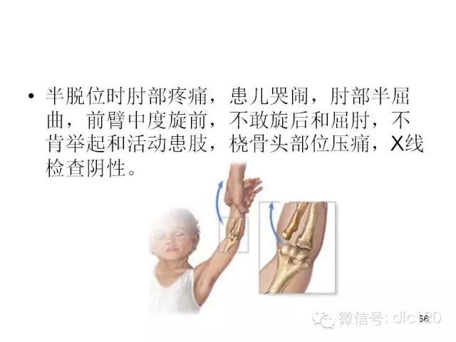 儿童肘关节骨折X线诊断