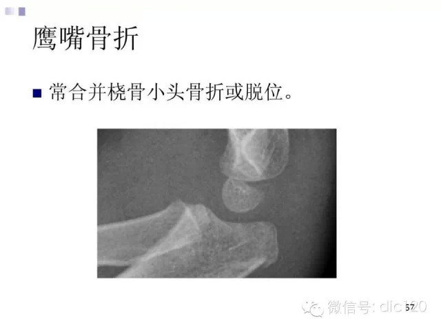 儿童肘关节骨折X线诊断