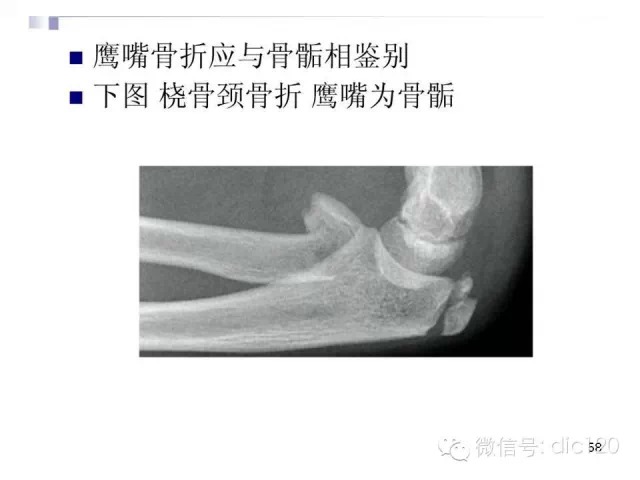 儿童肘关节骨折X线诊断