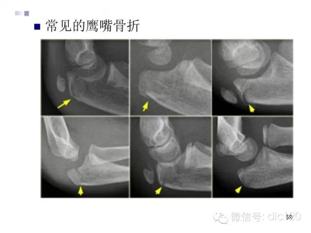 儿童肘关节骨折X线诊断