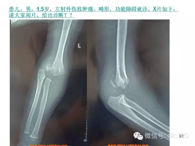 儿童肘关节骨折X线诊断