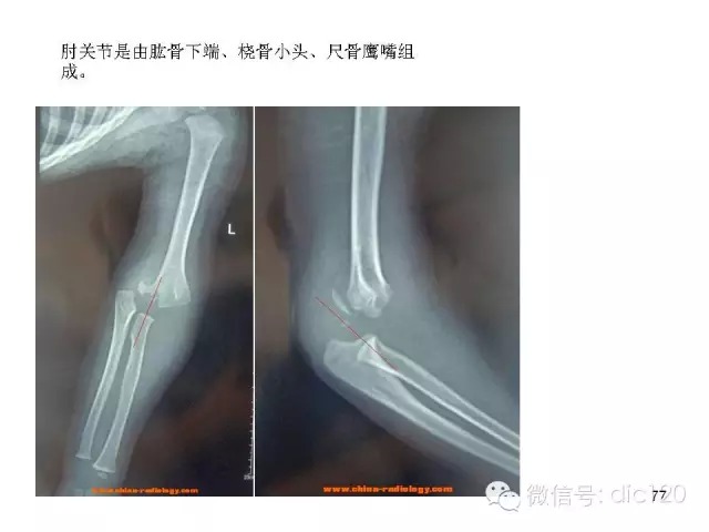儿童肘关节骨折X线诊断