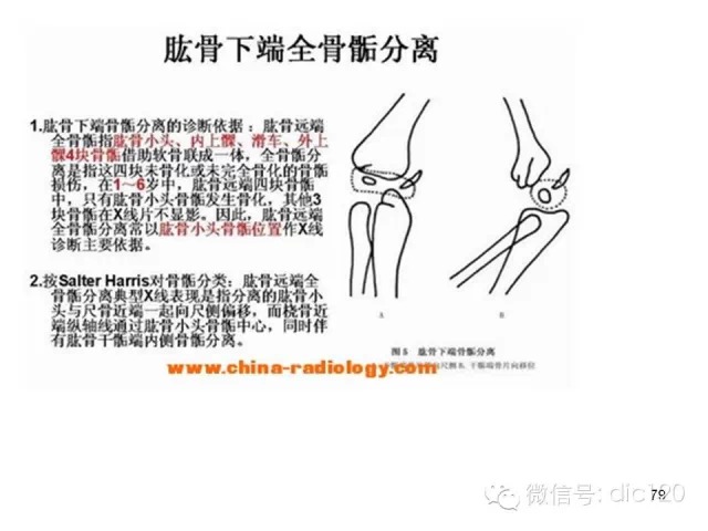 儿童肘关节骨折X线诊断