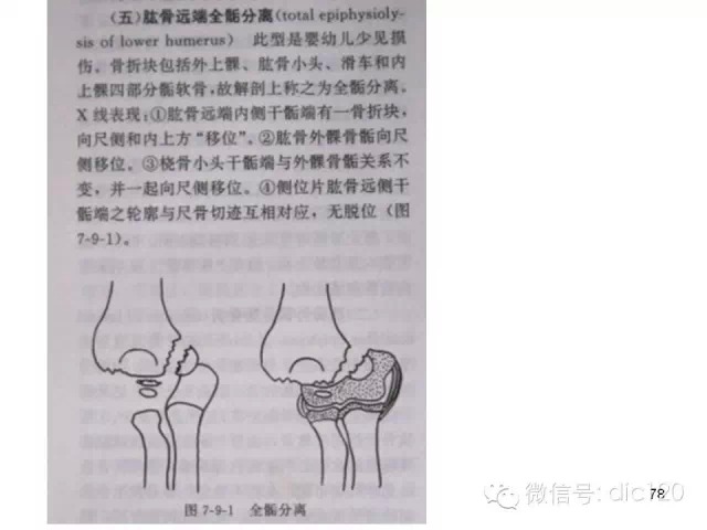 儿童肘关节骨折X线诊断