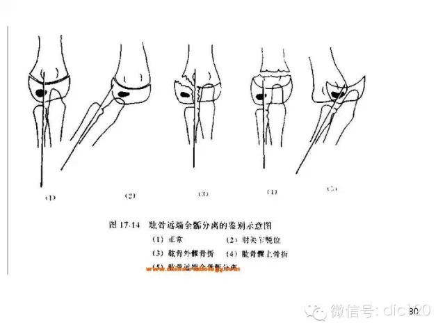 儿童肘关节骨折X线诊断
