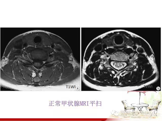 甲状腺常见疾病的影像表现与鉴别诊断