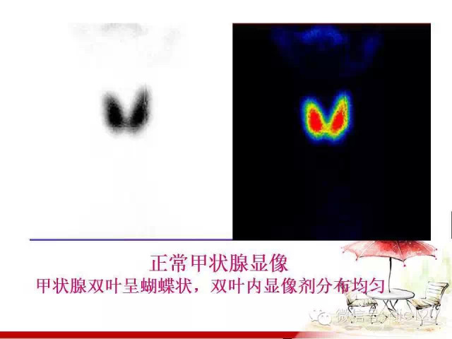 甲状腺常见疾病的影像表现与鉴别诊断