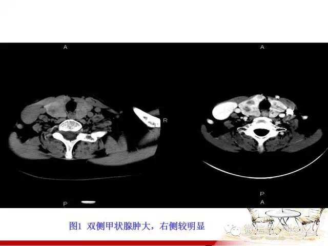 甲状腺常见疾病的影像表现与鉴别诊断