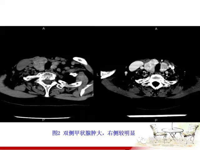 甲状腺常见疾病的影像表现与鉴别诊断