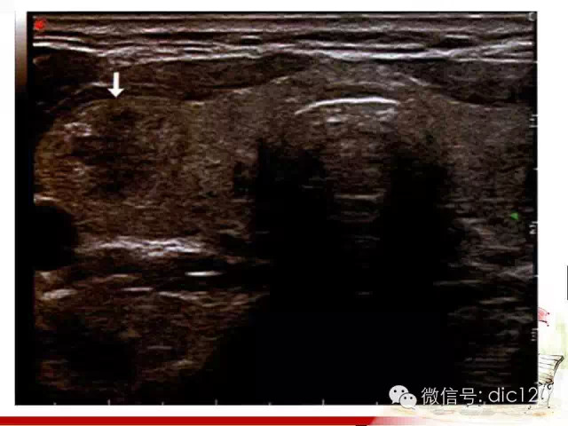 甲状腺常见疾病的影像表现与鉴别诊断