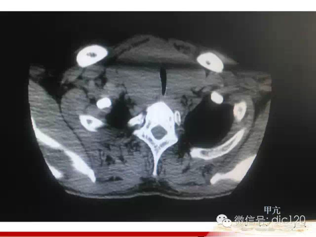 甲状腺常见疾病的影像表现与鉴别诊断