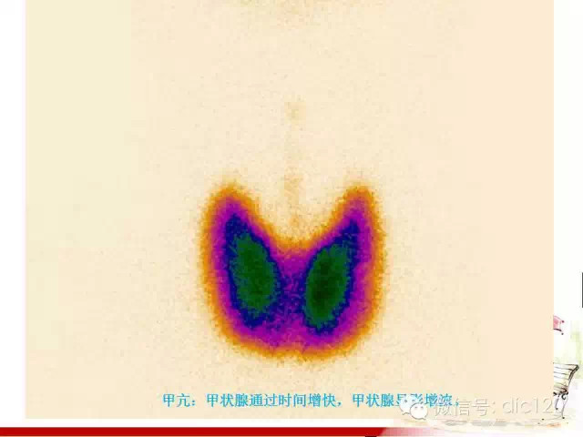 甲状腺常见疾病的影像表现与鉴别诊断