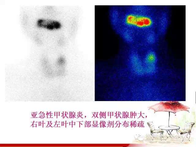 甲状腺常见疾病的影像表现与鉴别诊断